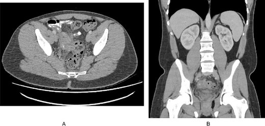 (A). Axial slice of a CT abdomen/pelvis in the portovenous phase demonstrating an inflammatory mass in the pelvis associated with the right pelvic side wall, with a calcific focus. (B). Coronal slice of the CT demonstrating the relation of the inflammatory mass within the pelvis.