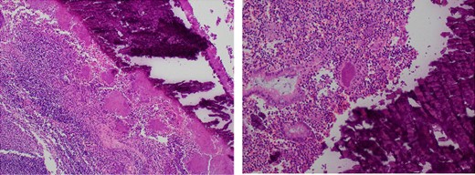 Microscopy slides demonstrating a luminal faecolith surrounded by Actinomyces.