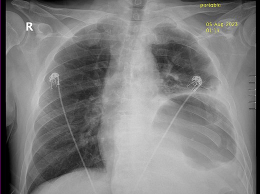 Chest X-ray showing gastric body in the left hemithorax.