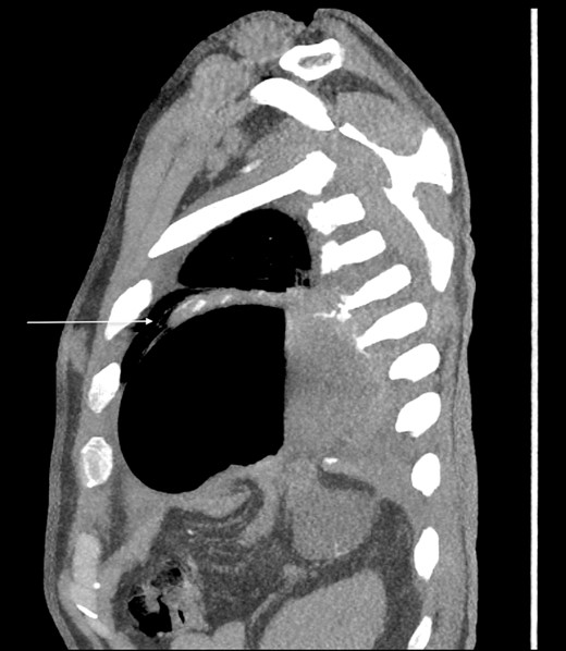 Sagittal CT showing gastric body herniating through diaphragmatic defect and the “dangling diaphragm” sign (arrow).