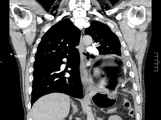 Coronal CT showing the gastric body herniating through diaphragmatic defect, discontinuity of the diaphragm (thick arrow), and the “collar” sign (thin arrow).