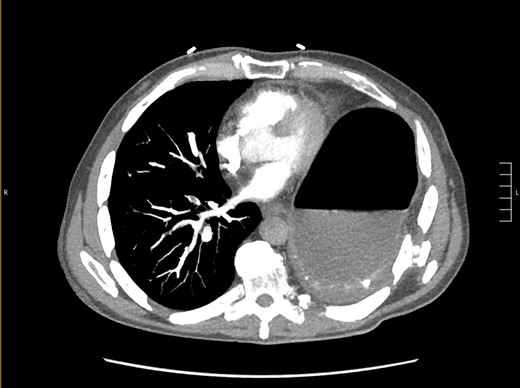 Axial CT showing previously fractured ribs, the “dependent viscera” sign, and thoracic fluid abutting abdominal viscera.