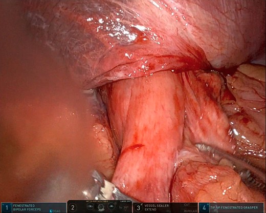 Intraoperative photo showing a large portion of the stomach herniating through the diaphragmatic defect. This photo shows the small portion that remained in the abdominal cavity.