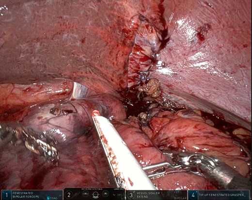Intraoperative photo showing the layered closure and plication of the diaphragmatic defect. Note the dusky areas of mucosa (bottom left) suggesting compromised perfusion of the herniated viscus.