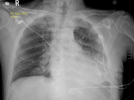 Postoperative Day 2 chest X-ray showing reduced diaphragmatic hernia and resolving pleural effusion.