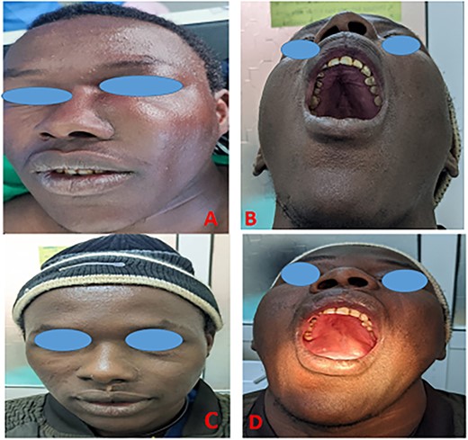 Photographs of the patient demonstrating facial asymmetry due to the maxillofacial mass extraorally (A), the mass protruding on the hard palate before surgery (B); an external appearance (C), the intraoral appearance of the patient 12 months after surgery, respectively.