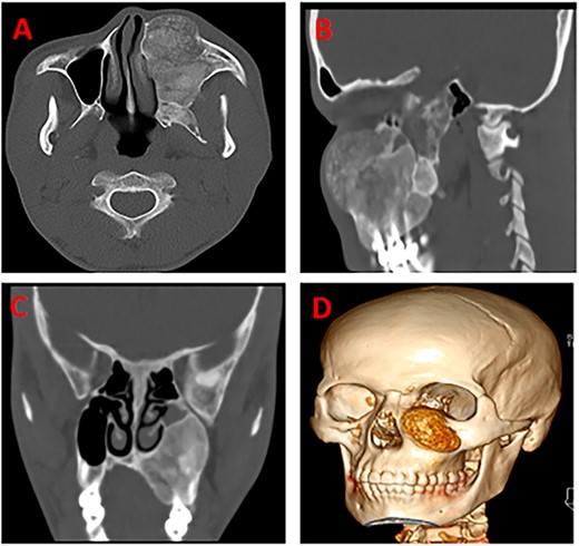 CT scans of the head highlighting a well-defined expansile radiolulency mass with radiopaque features (A), the mass is causing bone erosion (B), and opacification (C), a 3D of the tumor (D), respectively.