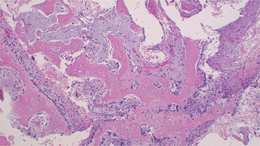 Photomicroscopy of ossifying fibroma demonstrating a benign fibro-osseous nature of the lesion composed of diffuse hyperchromatic stromal fibroblastic cell proliferation, without atypia, or mitoses. The matrix is mineralized with woven and lamellar bone deposits or cementum-like calcifications distributed throughout the lesion, H & E staining at 200 × original magnification.