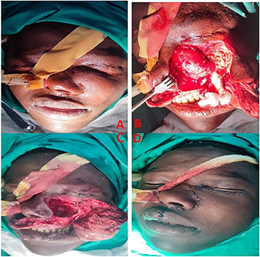 Photographs showing endotracheal intubation via the nasal cavity (A), surgical exposure of the tumor (B), and excision of the tumor through a Weber– Ferguson approach (C); the surgical wound primarily closed with the advancement of nearby muscles and skin in layers in a water tight fashion (D), respectively.