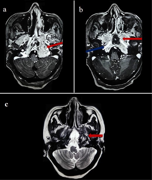 Cerebral MRI (axial views) showing a 65-mm lesion centered on the sphenoid bone (red arrow) with extension to the internal carotid artery (blue arrow), demonstrating iso-intensity with mild heterogeneous enhancement on T1-weighted (a, b) and hypo-intensity on T2-weighted (c).