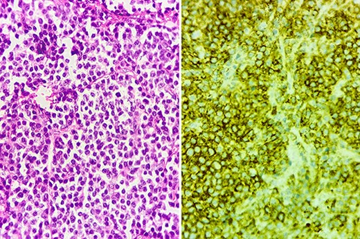 Histology section showing diffuse dystrophic plasma cells predominantly mature (left), with positive CD138 staining on immunohistochemistry (right).