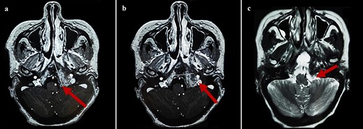 Cerebral MRI (axial views) showing a relapse of the sphenoid BP measuring 70 mm (a, b: T1 weighted post-gadolinium; c: T2 weighted).