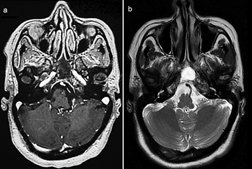 Control cerebral MRI (axial views) showing the disappearance of the sphenoid BP after treatment with RTX and immunochemotherapy. (a: T1-weighted; b: T2-weighted).