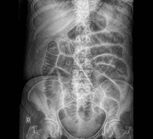 Abdominal X-ray: generalized dilatation of the small intestine without distal air in the colon or the rectum.