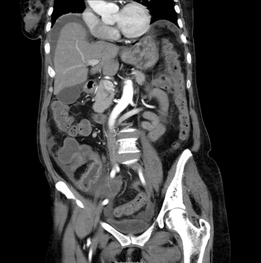 CT scan: sudden change of caliber at the terminal ileum together with signs of intestinal suffering.