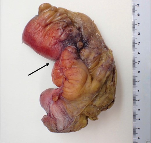Macroscopic pathological examination: mesenteric hypertrophy surrounding the mesoileum causing stricture of the intestinal lumen.