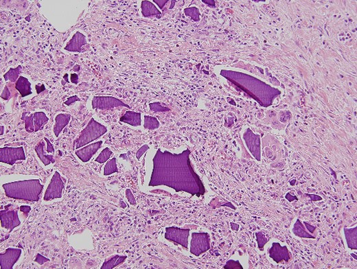 Microscopic pathological examination: abundant calcium polystyrene sulfonate crystals along the intestinal wall surrounded by intense inflammatory infiltrate.