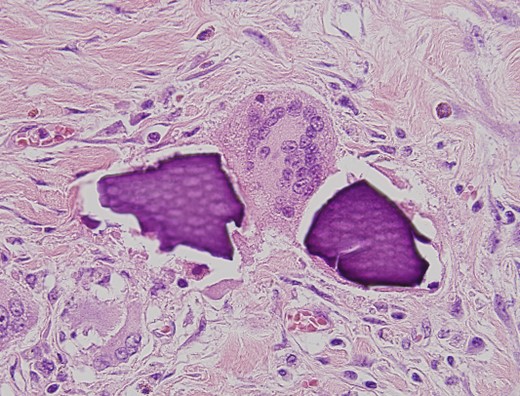 Multinucleate giant cell trying to phagocytize calcium polystyrene crystals.