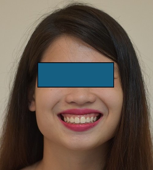 Initial patient smile.