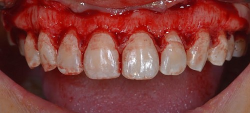 A full thickness flap was reflected.