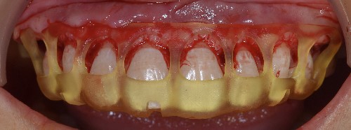 The tray, resting on the bone, is positioned correctly.