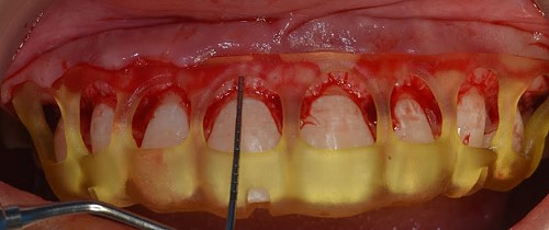 The bone crest is anticipated to be 3 mm from CEJ.