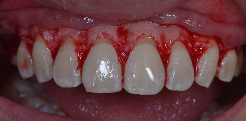 Crestal bone after grinding.