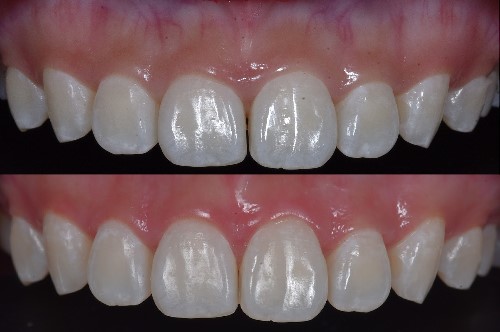 Postoperative results at 2 months.