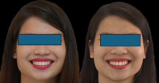 The final outcomes closely resembled the DSD simulation.