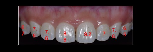 The clinical crown length.