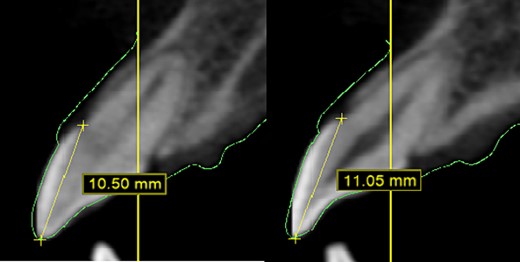 In CBCT, determine the CEJ of each tooth to ascertain the anatomical crown length.