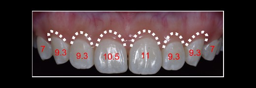 Simulation of the anatomical crown length.