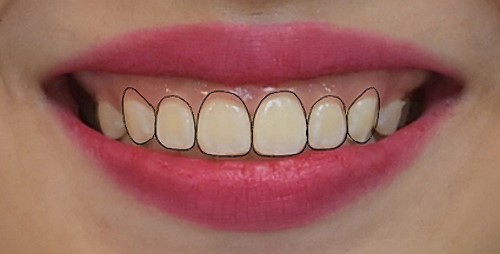 DSD with the anticipated gingival margin determined by the CEJ location.