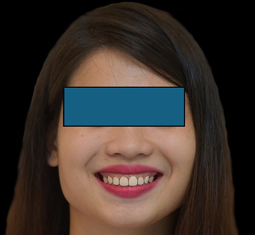 Simulation smile.