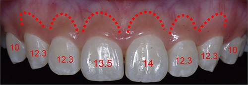 Simulating the position of the proposed bone margin 3 mm apical to the anticipated gingival margin.