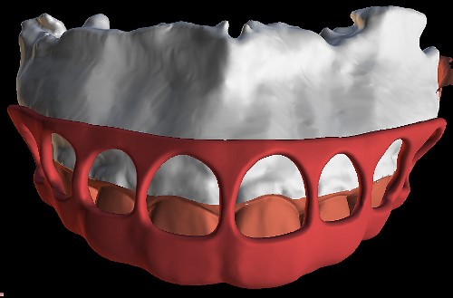 Digitally planned surgical guide.