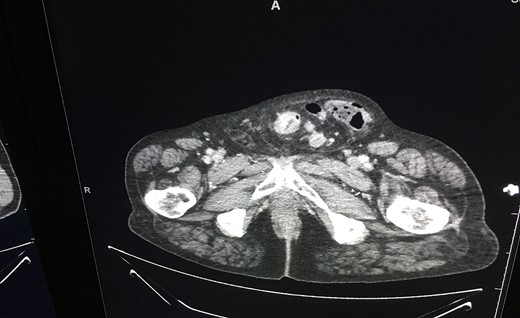 Preoperative image of tumour within the scrotum.