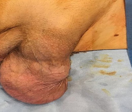 CT scan showing the tumour within the scrotum.