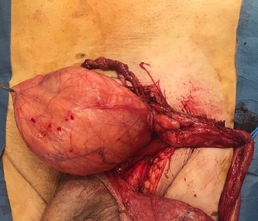 Intraoperative image of tumour within the hernia sac.