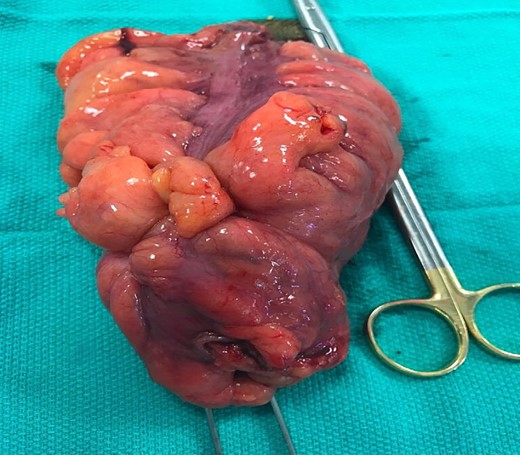 Tumour postresection.