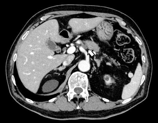 Computed tomography after preoperative chemotherapy showing tumor invasion on the left side of the celiac artery.