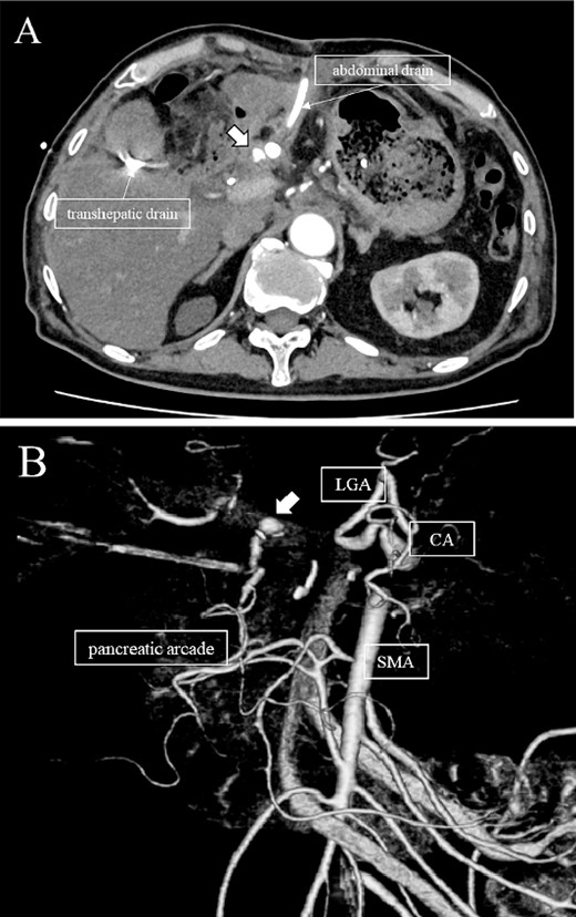 (A, B) CT on postoperative day 48. Contrast-enhanced CT showing a pseudoaneurysm at junction of the GDA and PHA (arrow).
