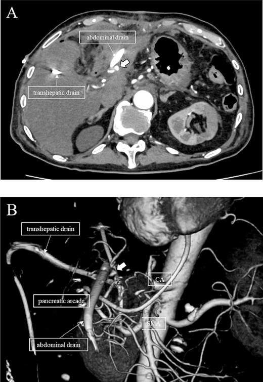 (A, B) CT on postoperative Day 56. Contrast-enhanced CT shows a pseudoaneurysm at junction of the GDA and PHA (arrow).