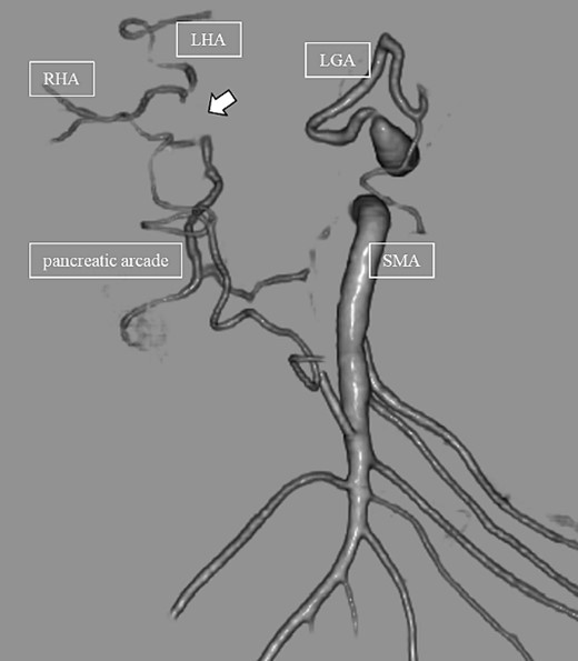 CT on postoperative Day 61. Although blood flow in the PHA could not be confirmed (arrow), the right and left hepatic arteries are preserved.