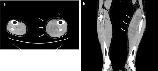 Contrast-enhanced computed tomography examination of both lower limbs. Obvious venous thrombosis was not observed in the lower extremity vessels. Significant edema was observed in the soleus and gastrocnemius muscles of the left lower leg. (a) Horizontal and (b) coronal sections.