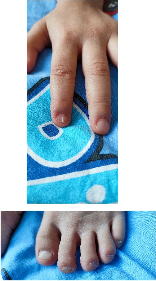 Paper-thin nails—both on hand and foot.