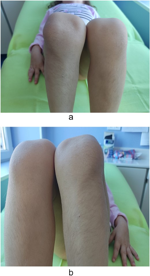 Lateralization of patella—clinical findings.