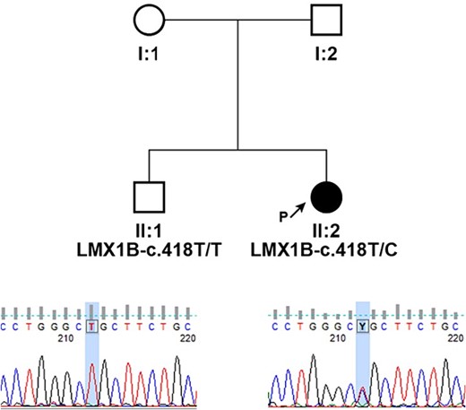 Pedigrees of presented family and segregation analysis of identified c.418 T > C (p.Cys140Arg) in LMX1B; individuals are identified by pedigree number; squares indicate males, circles indicate females, solid symbols indicate affected individuals, open symbols indicate unaffected individuals, and black arrow indicates the proband; sequencing chromatograms showing mutation segregation in the healthy brother is presented.