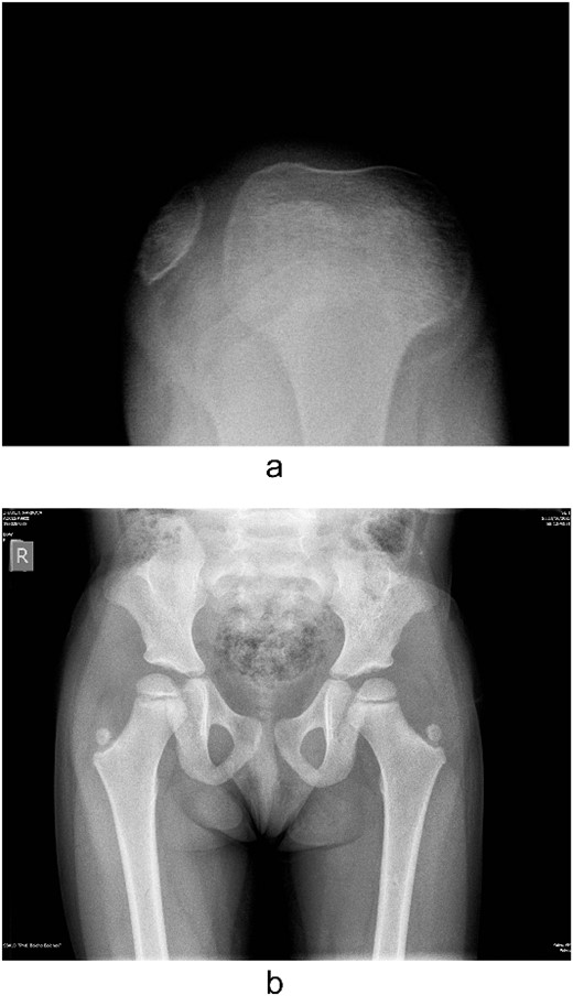 Lateralization of the patella in axial view and iliac horns.