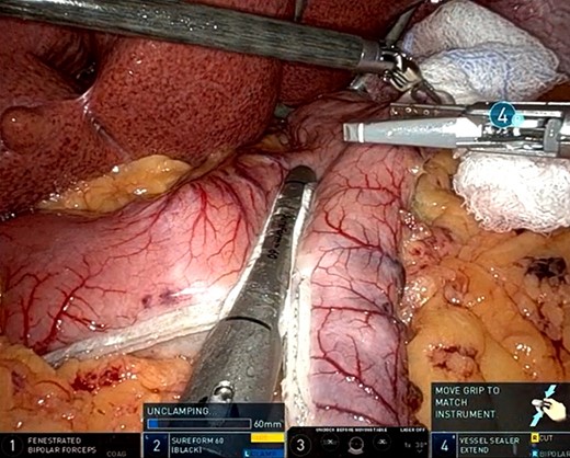 Robotic assisted sleeve gastrectomy.